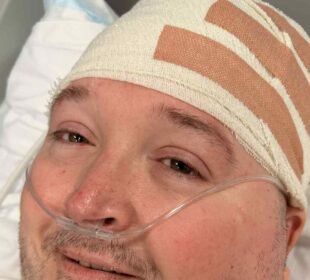 Neuralink şirketinin geliştirdiği N1 beyin çipi